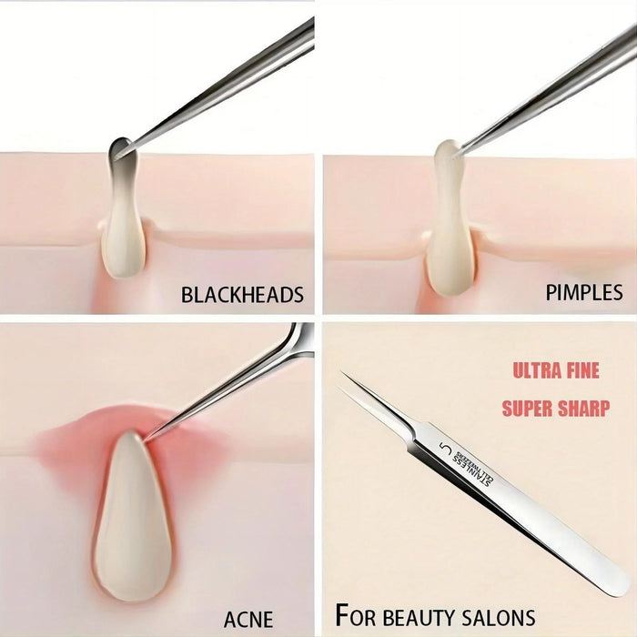 1pc Extra Fine No. 5 Cellular Acne Blackhead Tweezers - Facial Beauty Remove Acne Needle Tools for Skin Care